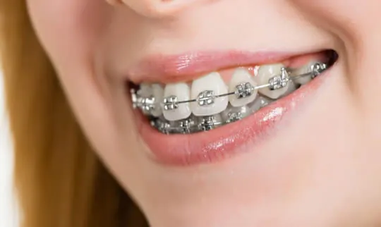 metal braces close up