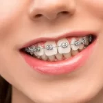 close up of girl with metal braces