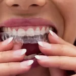 invisalign clear aligners on teeth