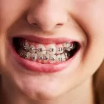 young girl smiling with metal dental braces