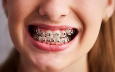 Traditional Braces: Reliable and Effective Solutions for Teeth Alignment